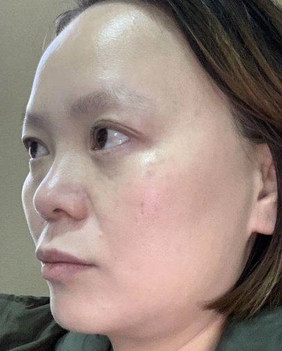 去眼袋手术