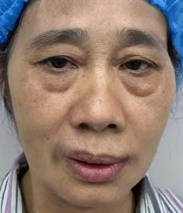 去眼袋手术