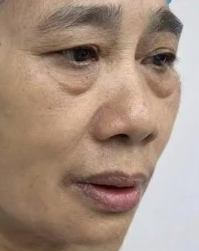 去眼袋手术