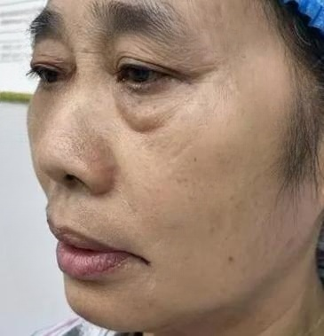 去眼袋手术