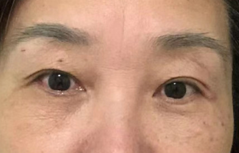 去眼袋手术