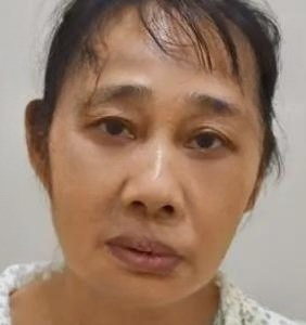 去眼袋手术