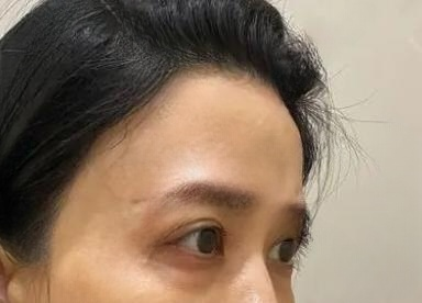 去眼袋手术