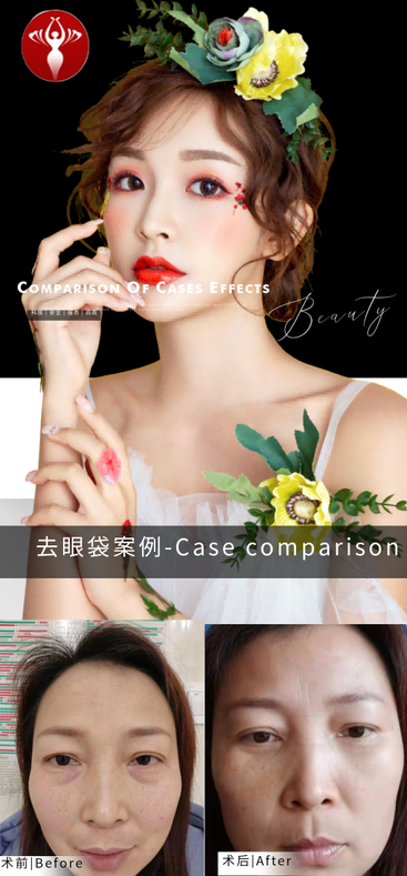 去眼袋手术
