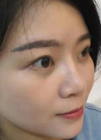 去眼袋手术