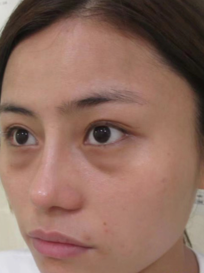 去眼袋手术