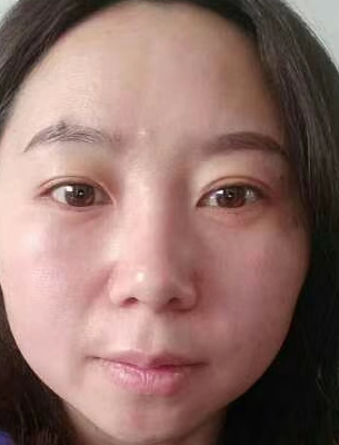 去眼袋手术