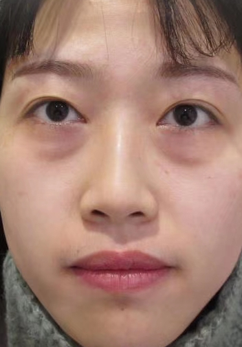 去眼袋手术