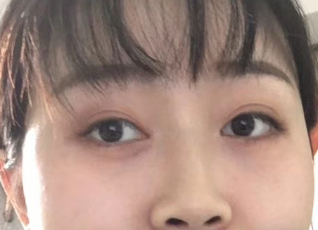 去眼袋手术