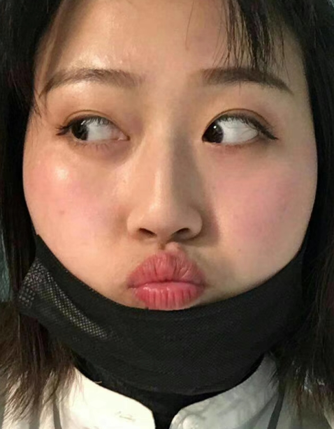 去眼袋手术