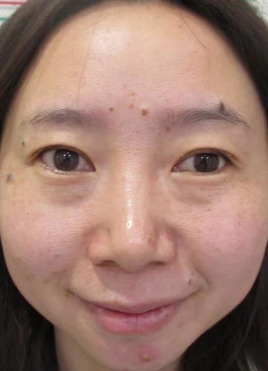 去眼袋手术