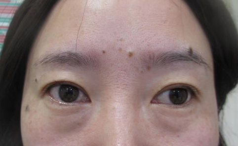 去眼袋手术
