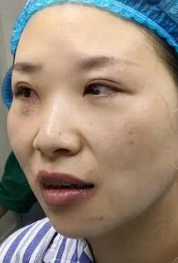 去眼袋手术