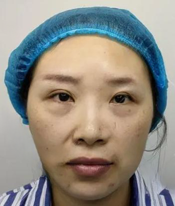 去眼袋手术