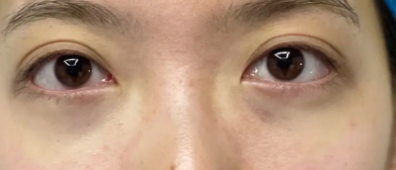 去眼袋手术