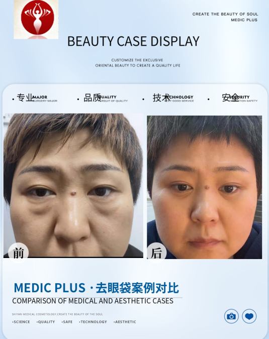 去眼袋手术