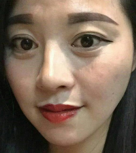 去眼袋手术