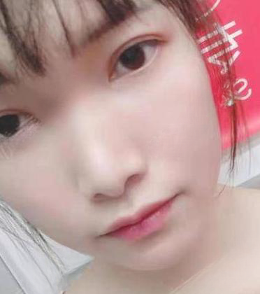 去眼袋手术
