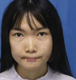 去眼袋手术
