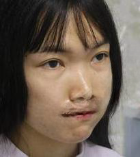 去眼袋手术