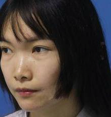 去眼袋手术