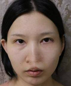 去眼袋手术