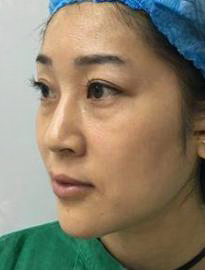 去眼袋手术