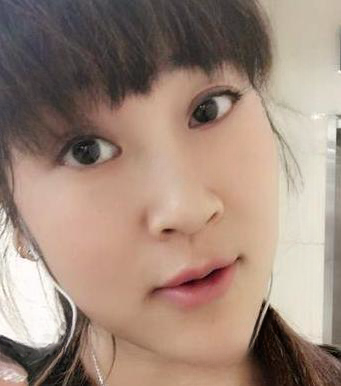 去眼袋手术