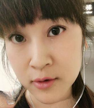 去眼袋手术