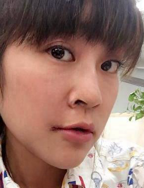 去眼袋手术
