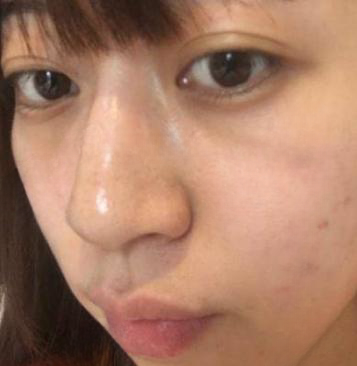 去眼袋手术