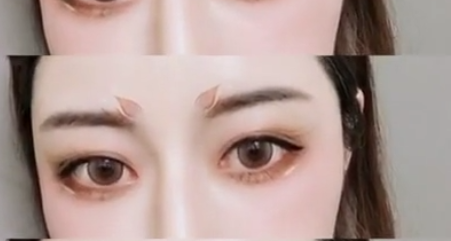 去眼袋手术