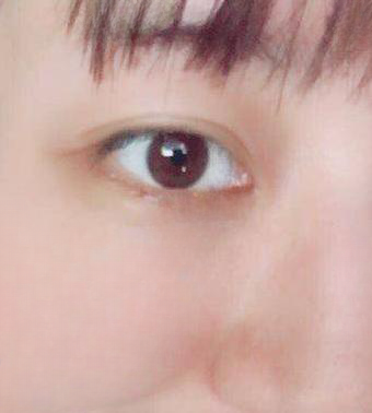 去眼袋手术