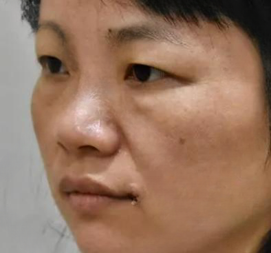 去眼袋手术