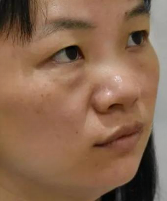 去眼袋手术