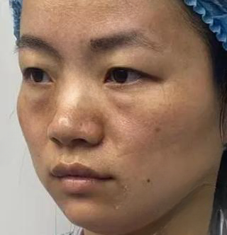 去眼袋手术