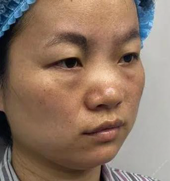 去眼袋手术