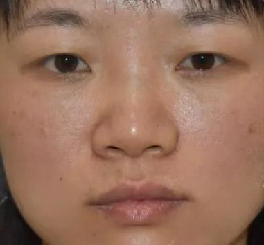 去眼袋手术