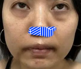 去眼袋手术