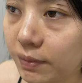 去眼袋手术