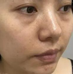 去眼袋手术