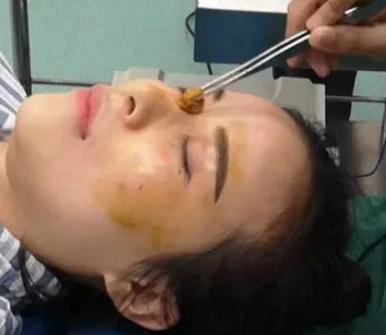去眼袋手术