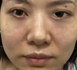 去眼袋手术
