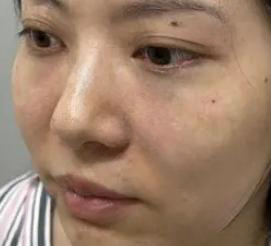 去眼袋手术