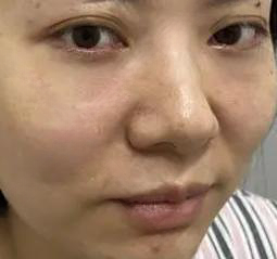 去眼袋手术