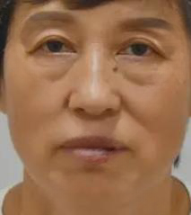 去眼袋手术