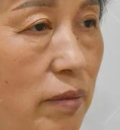 去眼袋手术