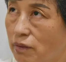 去眼袋手术