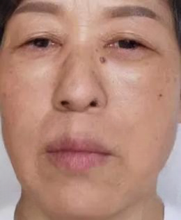 去眼袋手术