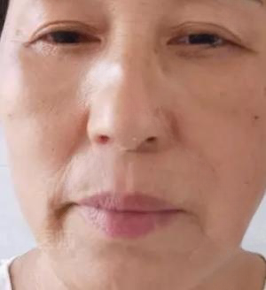 去眼袋手术